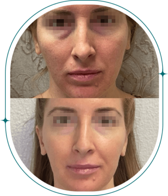 Before & After - Microneedling 2