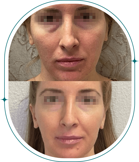 Before & After - Microneedling 2