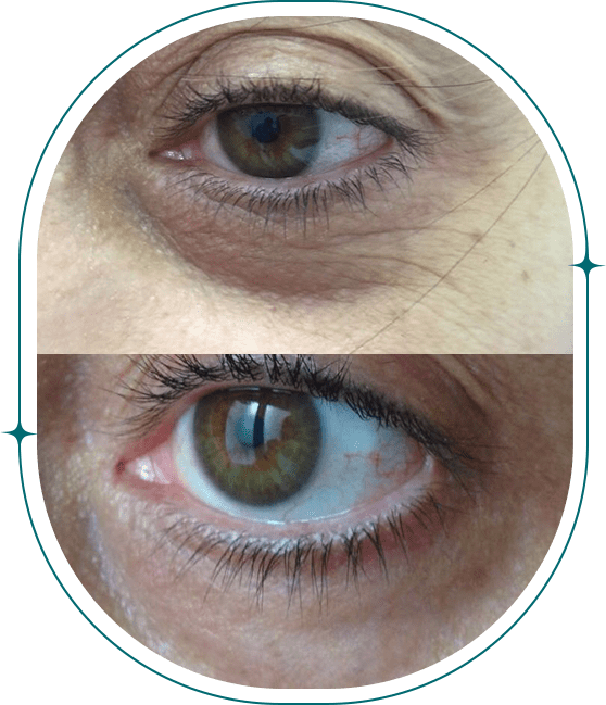 Before & After, Nonsurgical Eyelifts 1