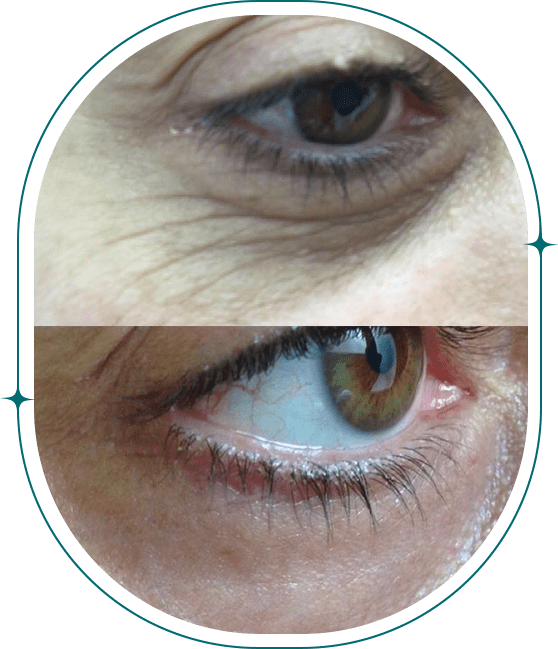 Before & After, Nonsurgical Eyelifts 2