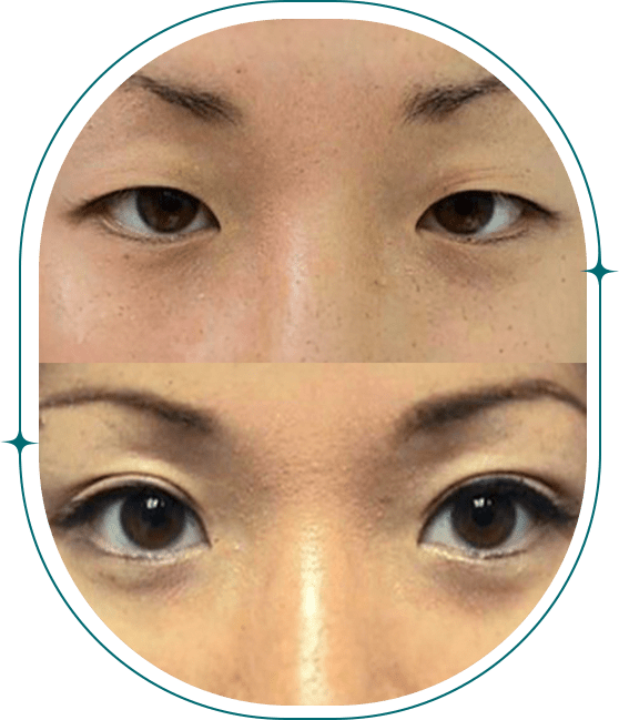 Before & After, Nonsurgical Eyelifts 4