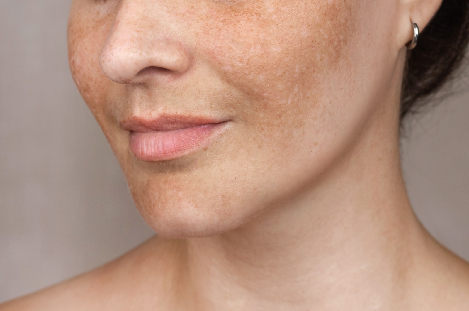 A close-up of a persons face with hyperpigmentation.