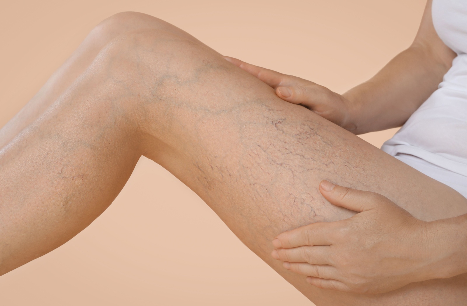 A close-up of a patient’s leg showing spider veins.