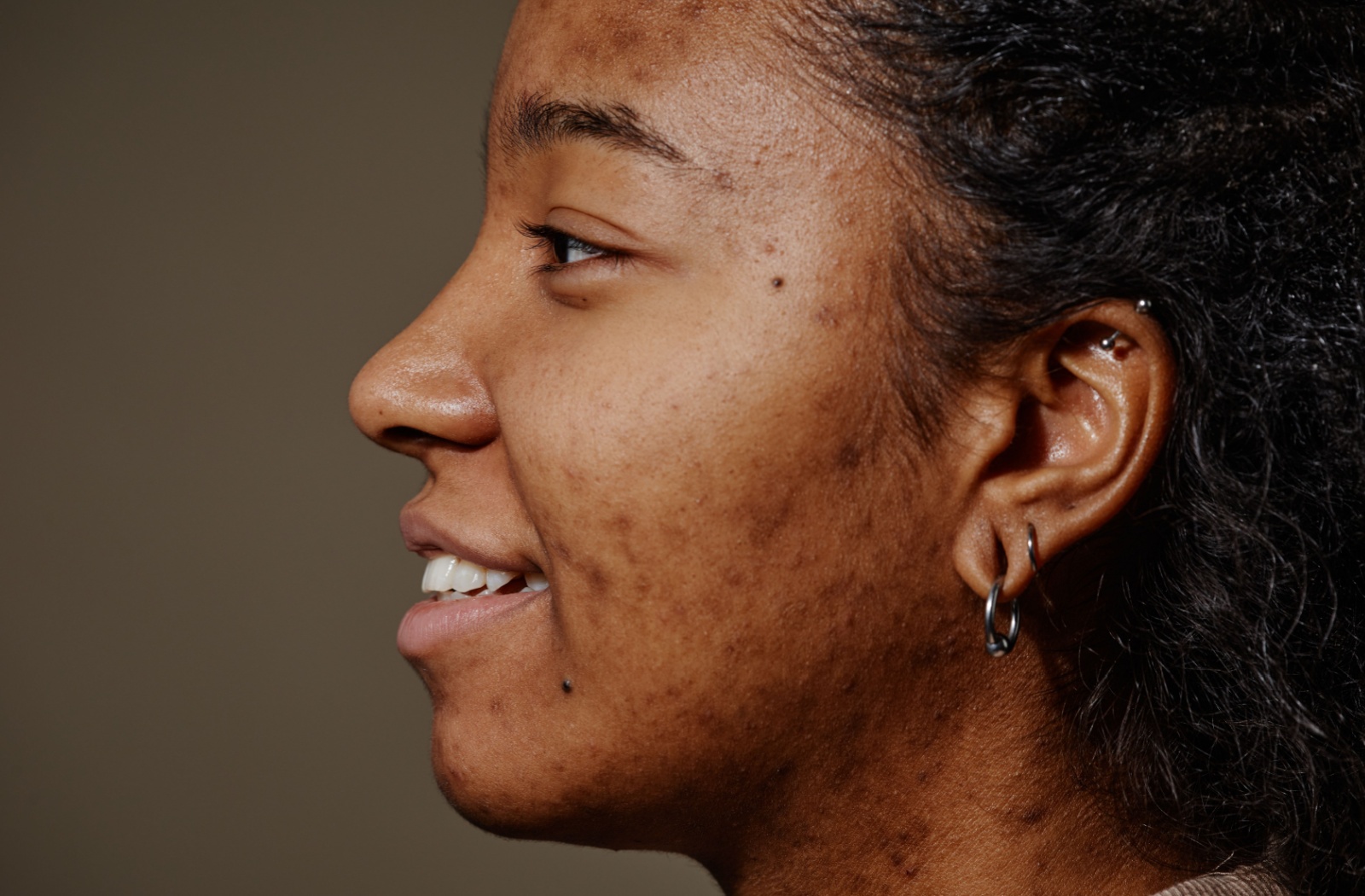 A person with acne scaring on their face.