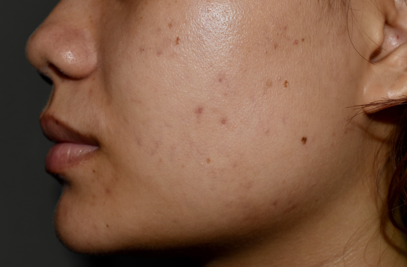 Close-up of a woman’s cheek showing dark spots and post-inflammatory hyperpigmentation from acne and sun exposure.