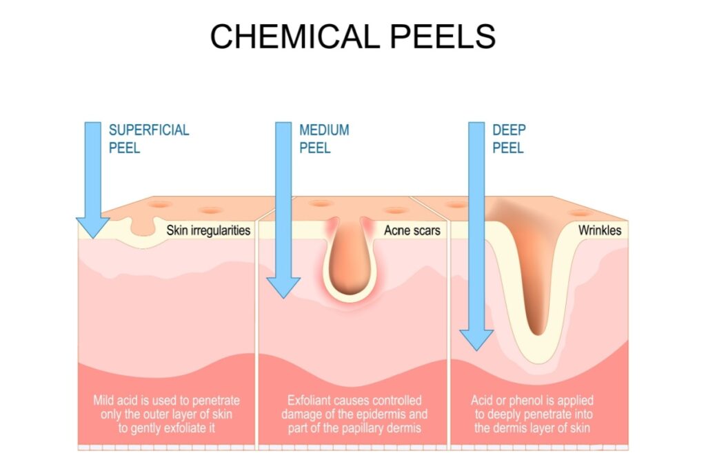 Diagram illustrating three depths of chemical peels: superficial for skin irregularities, medium for acne scars, and deep for wrinkles, showing penetration levels into skin layers.